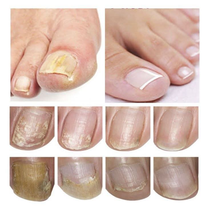 Say Goodbye to Nail Fungus Naturally