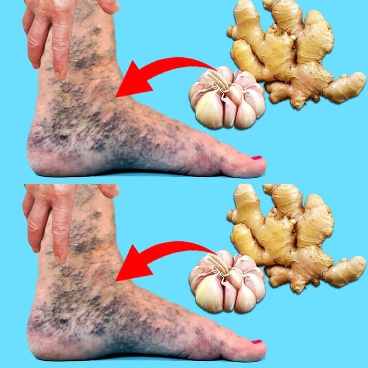Say goodbye to varicose veins