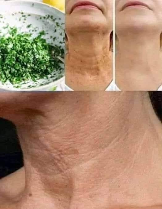 Natural Herbal Remedy for Smoother Firmer Neck Skin