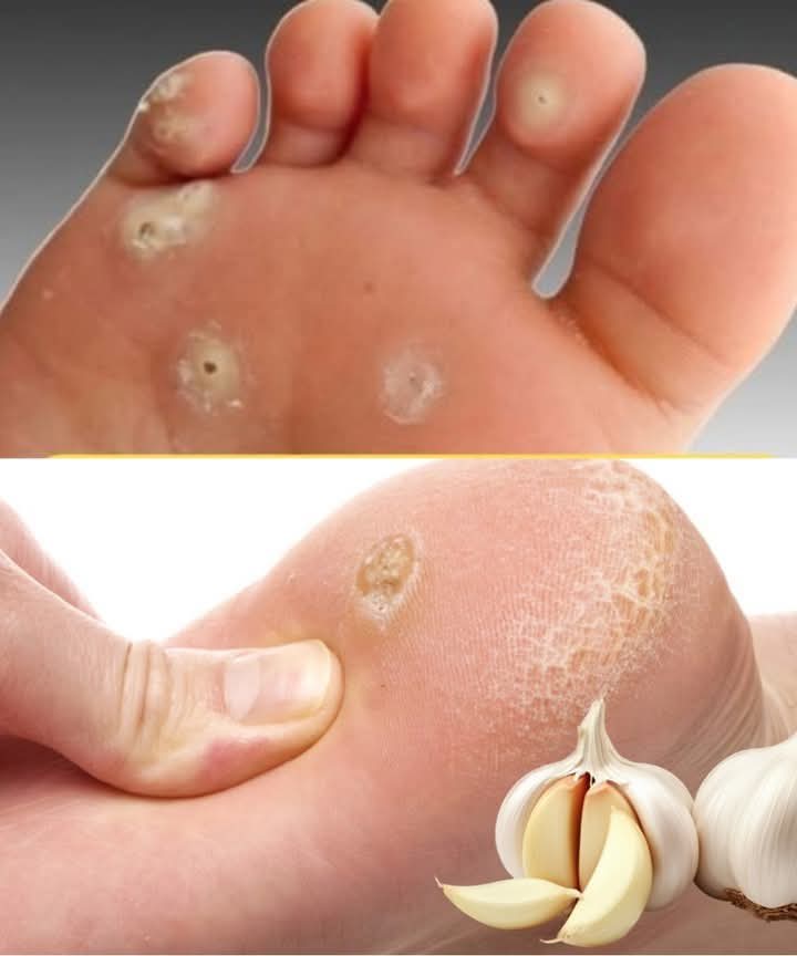 Eliminate Plantar Warts with These Natural Garlic Remedies