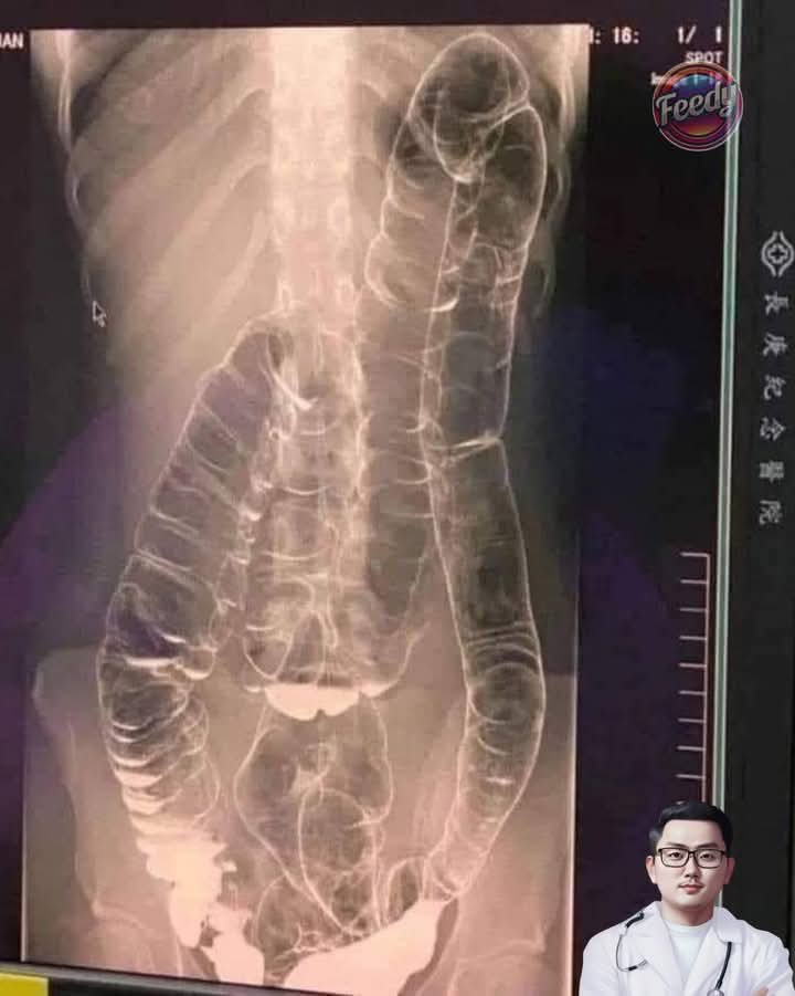 Severe Constipation and Toxic Megacolon: Causes and Solutions