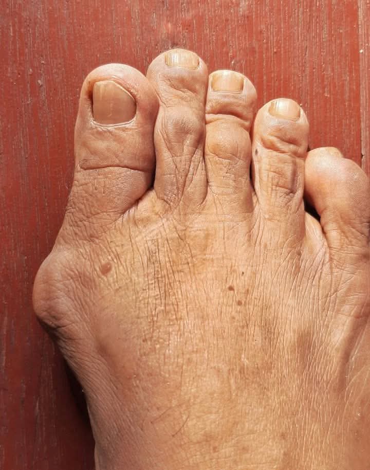 Getting painful swelling on the side of my big toe. Can’t get into a foot specialist fast.