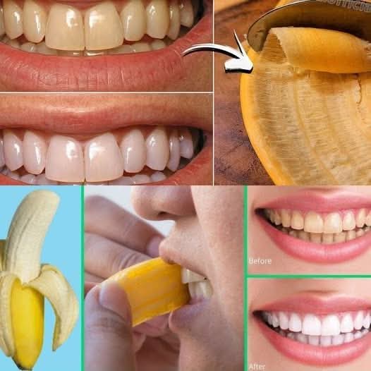 Easy & Natural Teeth Whitening with Banana Peels