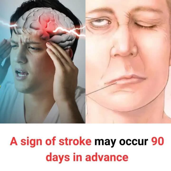 9 Early Warning Signs of Stroke