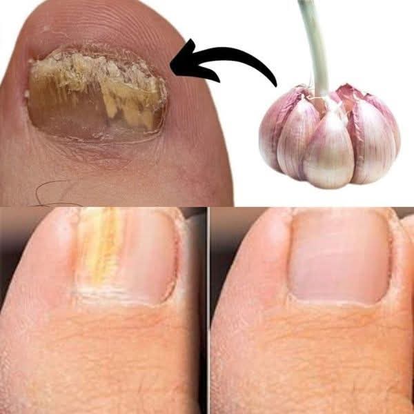 This Is a Nail Fungus Killer! It Works Very Fast – Just Use Garlic! 