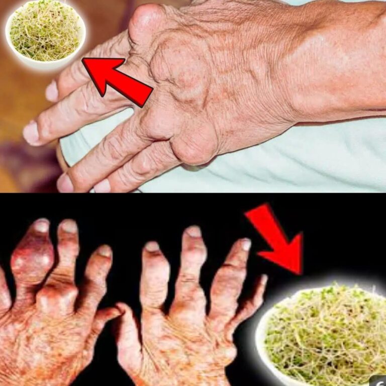 Discover the Natural Benefits of Alfalfa for Kidney Stones and Gout
