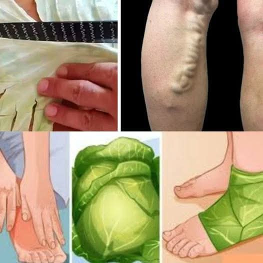 Natural Remedy for Varicose Veins Using Cabbage Leaves