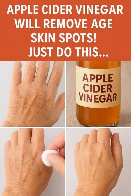 Apple Cider Vinegar Will Remove Age Skin Spots! Just Do This…