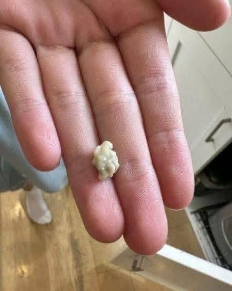 Tonsil Stones: What They Are and How to Get Rid of Them