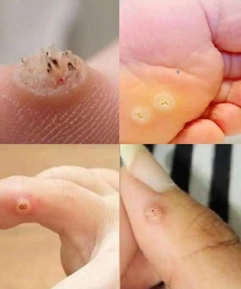 Pay Close Attention: This Type of Skin Growth Might Signal a Serious Issue
