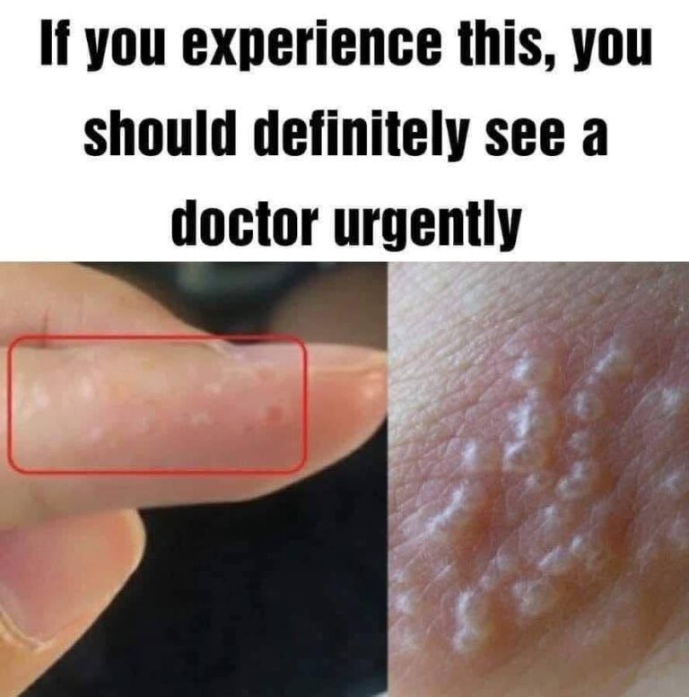 Painful Red Bumps? It Could Be Dyshidrotic Eczema