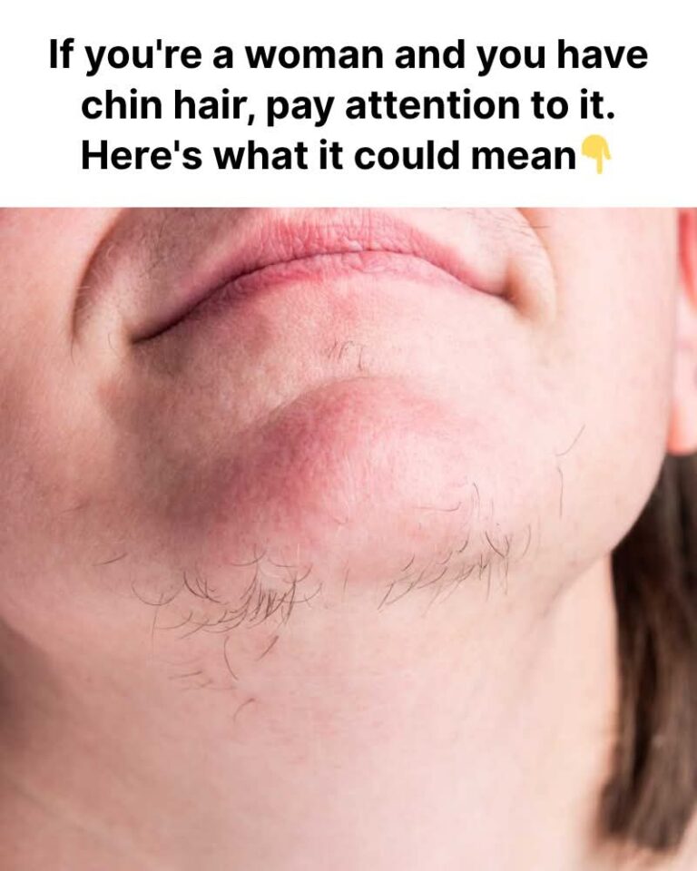 What Chin Whiskers Might Tell You About Your Health