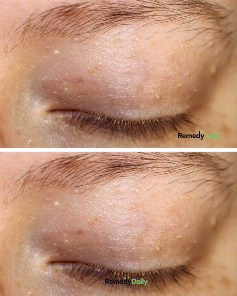 Got all these white bumps around my eyes.
