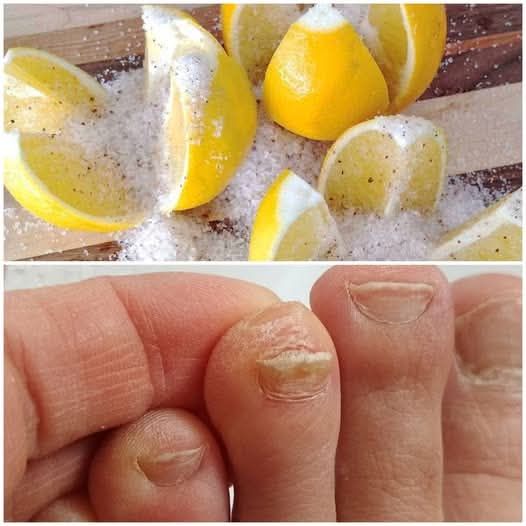 Nail Fungus Removal: 100% Natural Treatment for Toenail Fungus with Lemon Salt